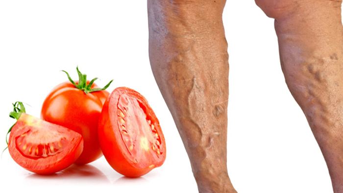 درمان خانگی واریس با گوجه فرنگی